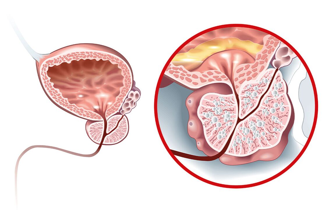 Ce se întâmplă cu prostata cu adenom și prostatită