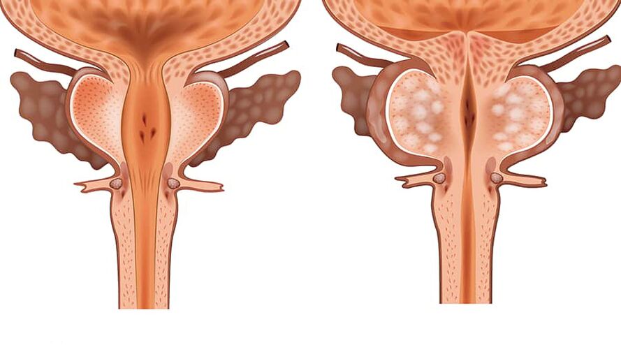 comparația dintre adenom sănătos și inflamat