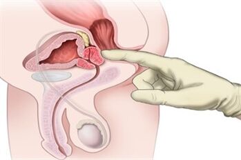 Masaj de prostată pentru tratamentul prostatitei cronice