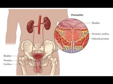 Prostatita - inflamație a glandei prostatei