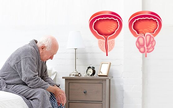 prostatita la un barbat